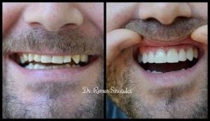 fatete dentare ceramica