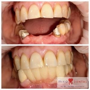 Implant dentar rapid Bredent