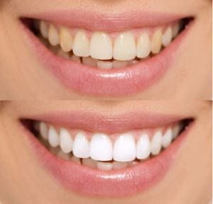 albire dinti cu laser bucuresti