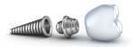 implant-dentar-pret