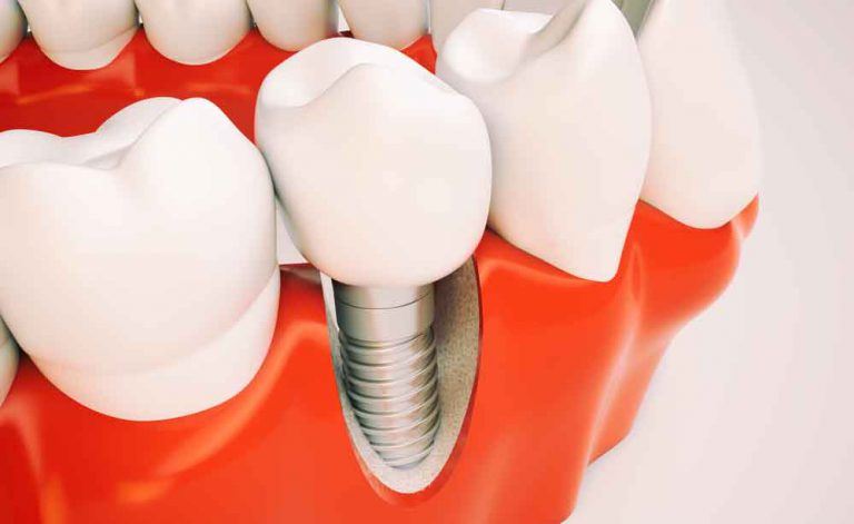 durata viata implant dentar