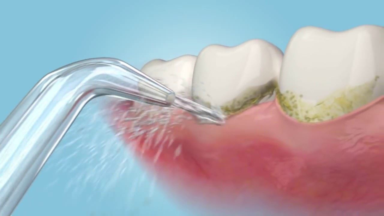 implant-dentar-igiena