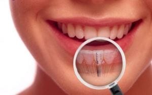 igiena-implant-dentar