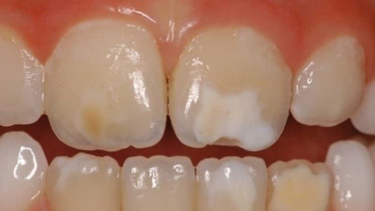 Demineralizarea dinților – cauze, simptome și soluții moderne de remineralizare