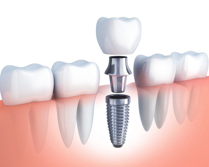 Pretul unui implant dentar