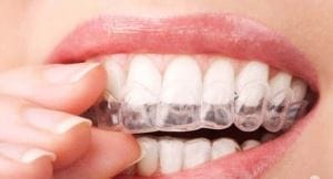 Aparat dentar invizibil Invisalign