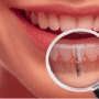 Ce indica pretul unui implant dentar complet?