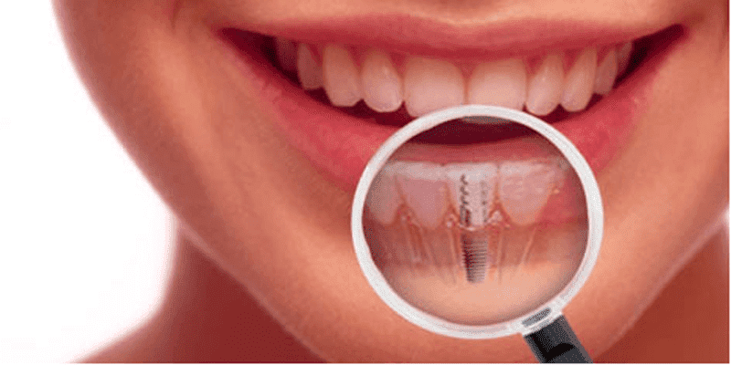 Ce Indica Pretul Unui Implant Dentar Complet Miko Dental