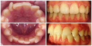 aparat dentar tratament ortodontic