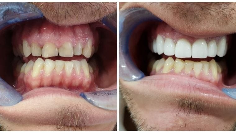 Fațete dentare EMAX sau Zirconiu – care rezistă mai mult în timp?