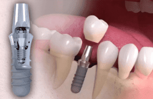 Pivot dentar versus implant dentar