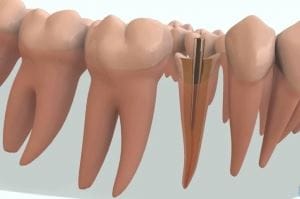 Pivot dentar
