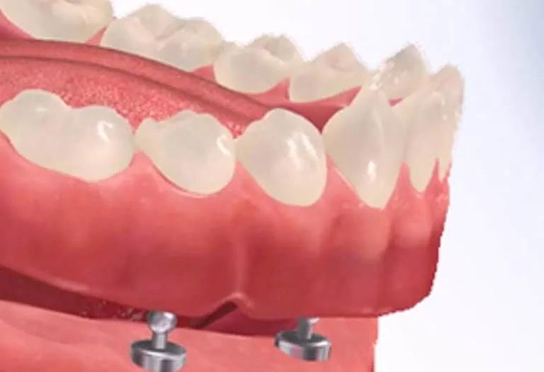 proteza capse fixa pe implant