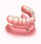 Beneficiile protezei dentare cu capse pe implant dentar