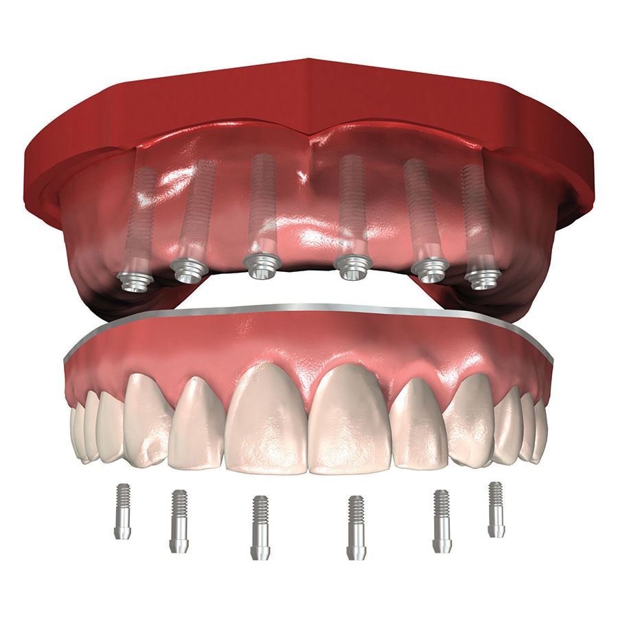 Proteza dentara pe implanturi: tipuri, caracteristici