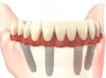 Proteza dentara pe implanturi: tipuri, caracteristici