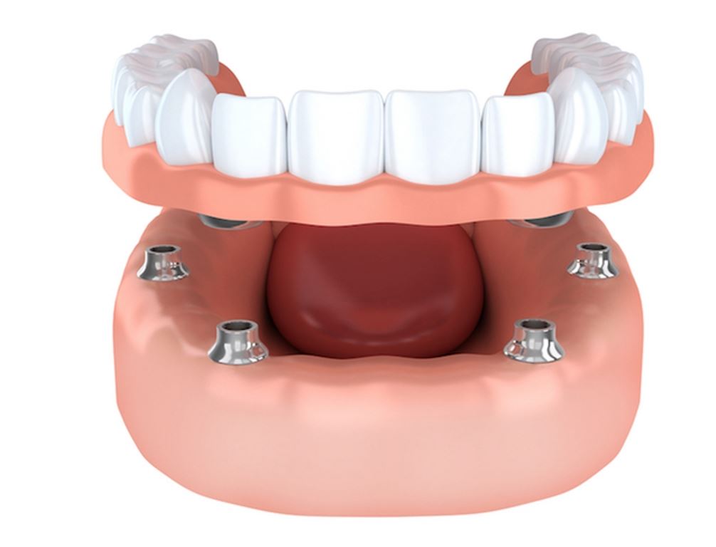 Proteza dentara pe implanturi