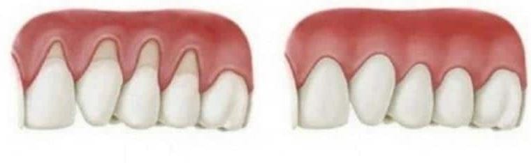 Retracția gingivală – Soluții avansate pentru un zâmbet sănătos