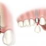 Tipuri si metode de inserare a implantului dentar
