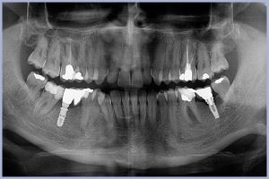 Evaluarea osului inainte de implantul dentar