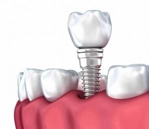 Optiuni de inlocuire a dintilor lipsa