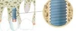 Osteointegrarea implanturilor dentare