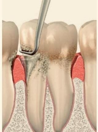 Tratamente pentru parodontoză – metode moderne și prevenție eficientă