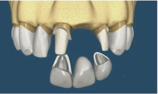 Inlocuirea dintilor: implant dentar sau punte dentara