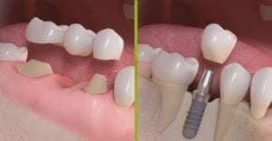 Inlocuirea dintilor: implant dentar sau punte dentara