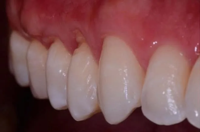 Retracția gingivală: simptome, cauze, tratament 