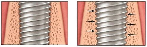 Osteointegrarea implanturilor dentare