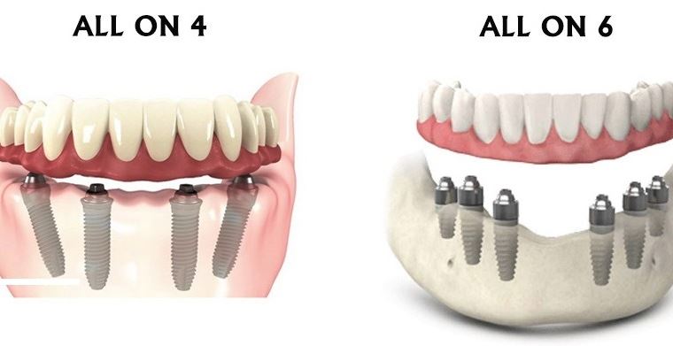 Restaurarea totala a danturii cu implanturi dentare
