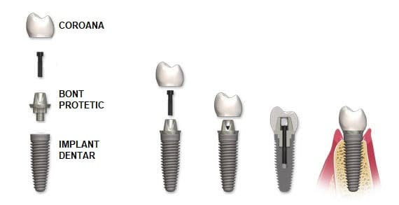 Avantajele implantului dentar