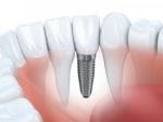 Recuperarea dupa implant dentar