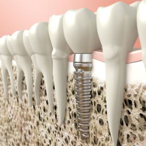 Riscuri si complicatii asociate implantului dentar