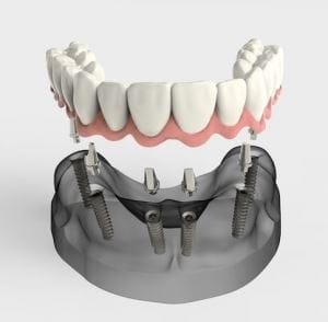 mplant dentar rapid Fast & Fixed