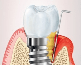 Riscuri si complicatii asociate implantului dentar
