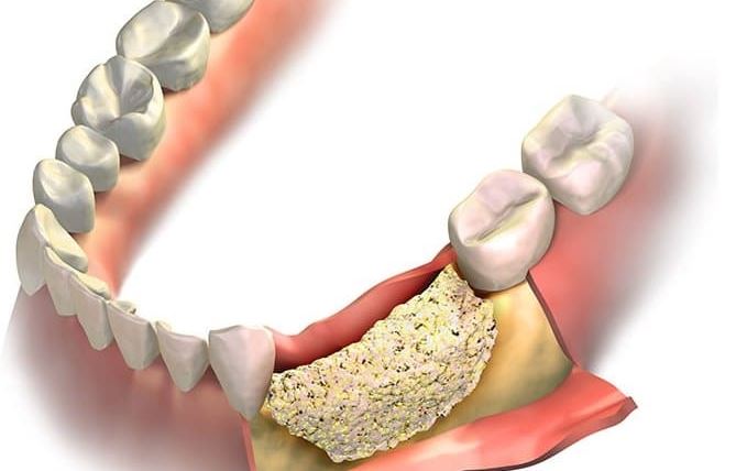 Aditia osoasa in cazul implantului dentar