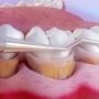Chiuretajul gingival in tratamentul parodontozei