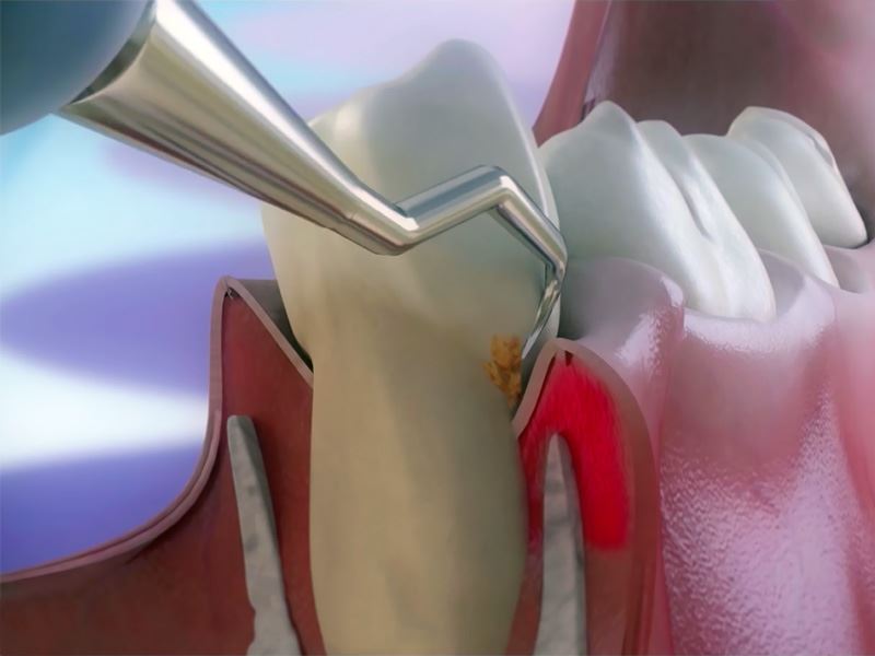 Chiuretajul subgingival și detartrajul în tratarea parodontitei