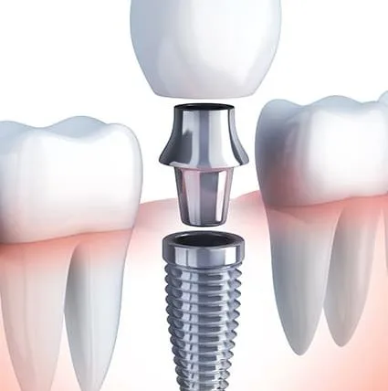 Implant dentar si proteza intr-o singura interventie