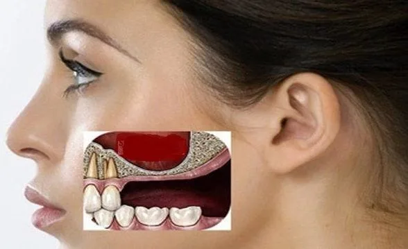 Sinus lift