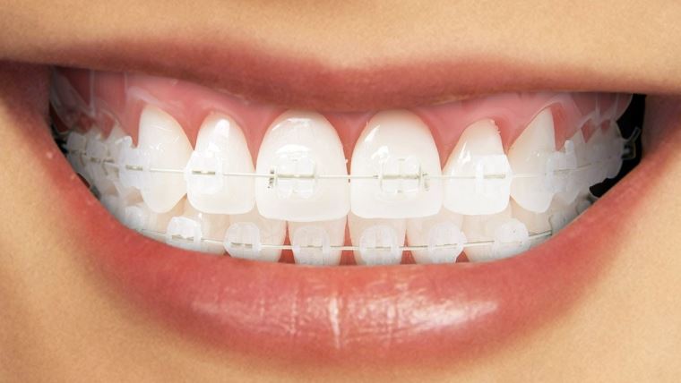 Aparatul dentar ceramic: caracteristici, avantaje, pret