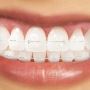 Aparatul dentar ceramic: caracteristici, avantaje, pret