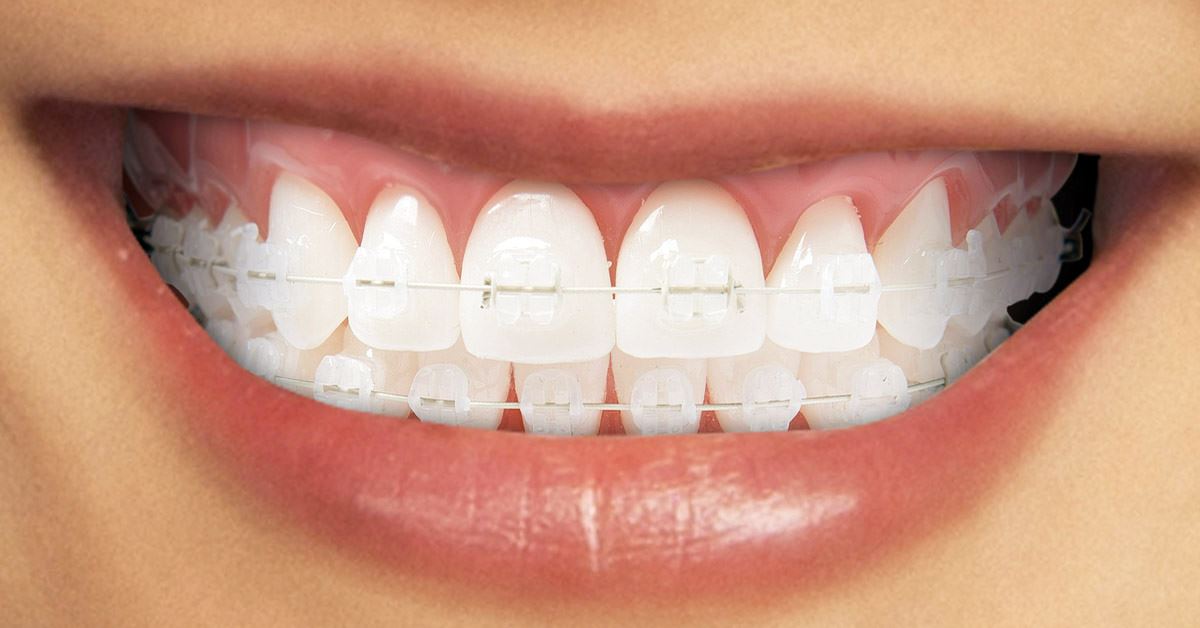 terrorism Invoice panic Aparatul dentar ceramic: caracteristici, avantaje, pret - Miko Dental