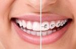 Aparat dentar safir invizibil