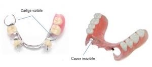 Proteza dentara scheletata