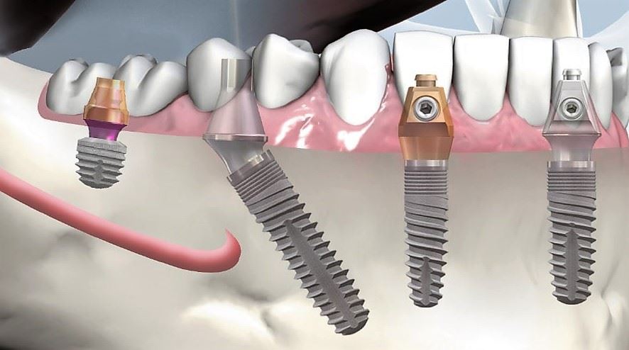 Implant dentar Bredent