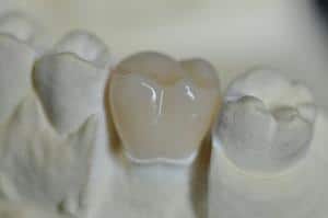 Coroana dentara zirconiu