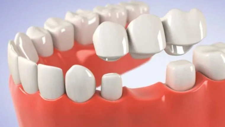 Tipuri de punti dentare: caracteristici, avantaje, preturi
